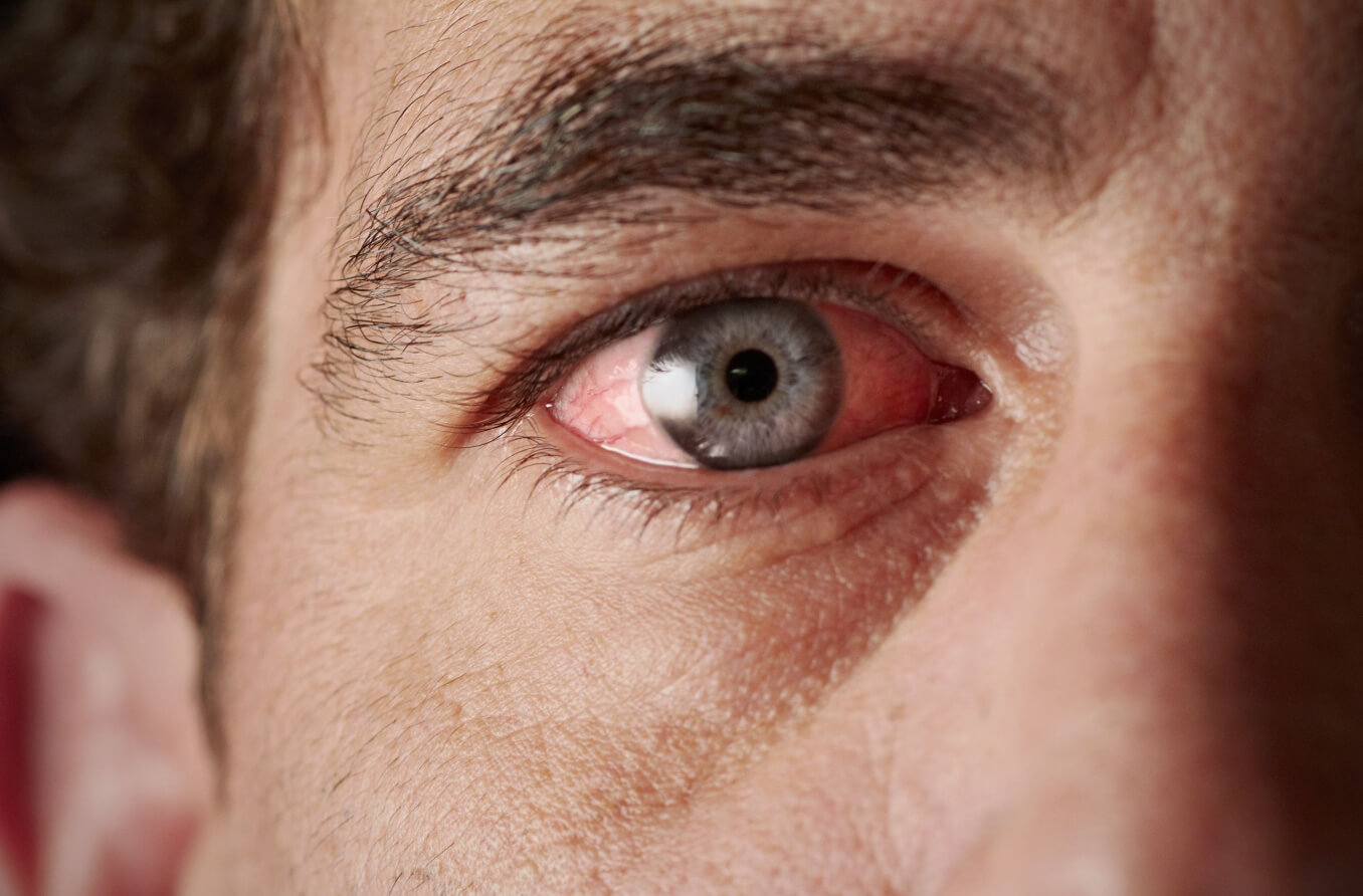 Rotes Auge: Was sind die Ursachen von roten Augen?