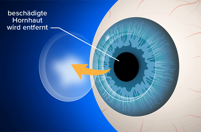 Hornhauttransplantation (Keratoplastik oder auch Hornhautplastik)