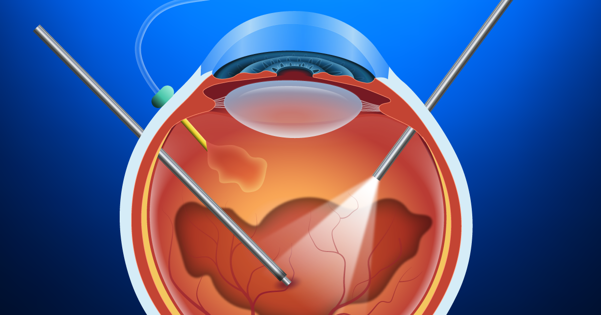 Vitrektomie und vitreoretinale Augenoperation