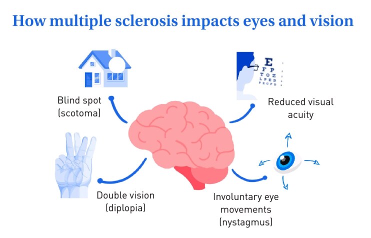Blurry vision in people with diabetes Blurry vision in people with diabetes