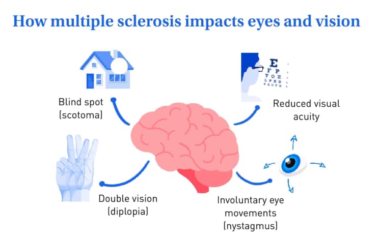 Blurry vision in people with diabetes