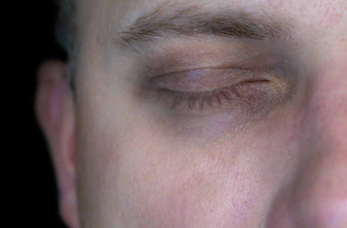 Ojeras: Como Quitar Las Ojeras? - Causas y Tratamiento