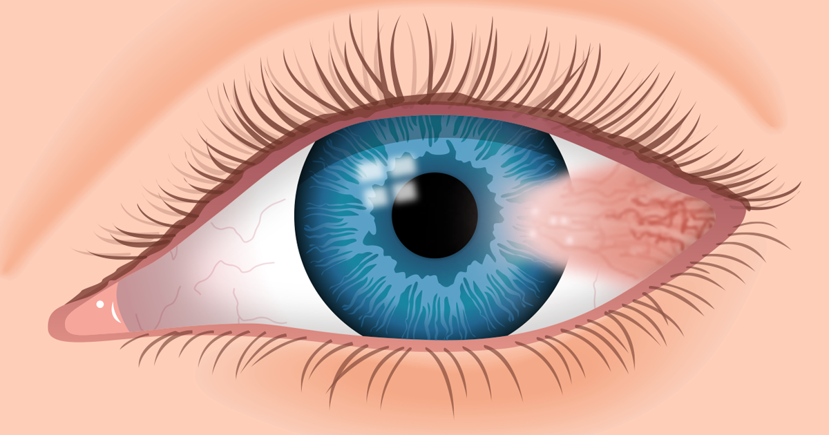 Pterigion: Causas y tratamiento | All About Vision