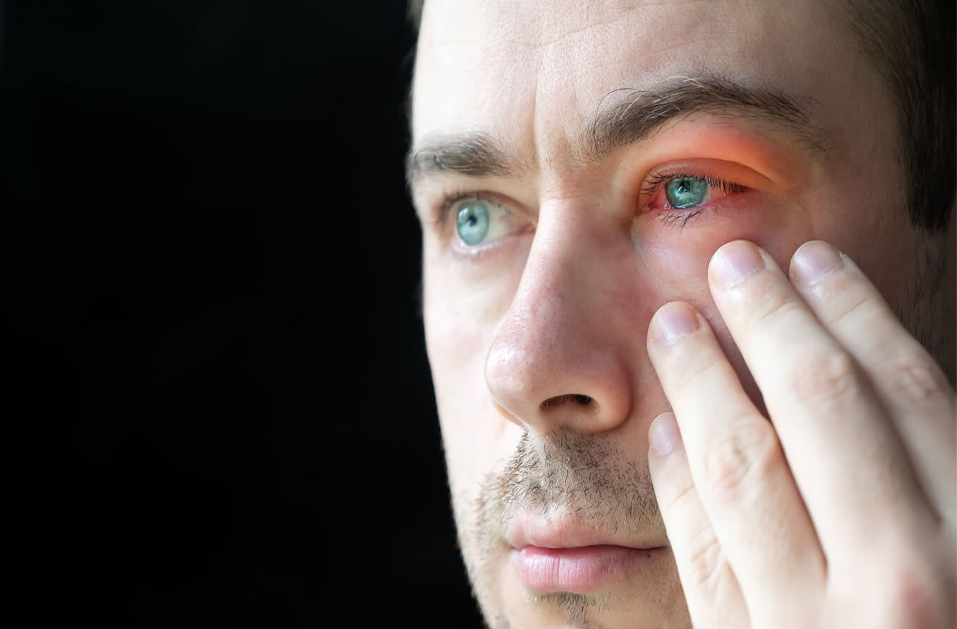 La picadura en el ojo: tipos y consejos