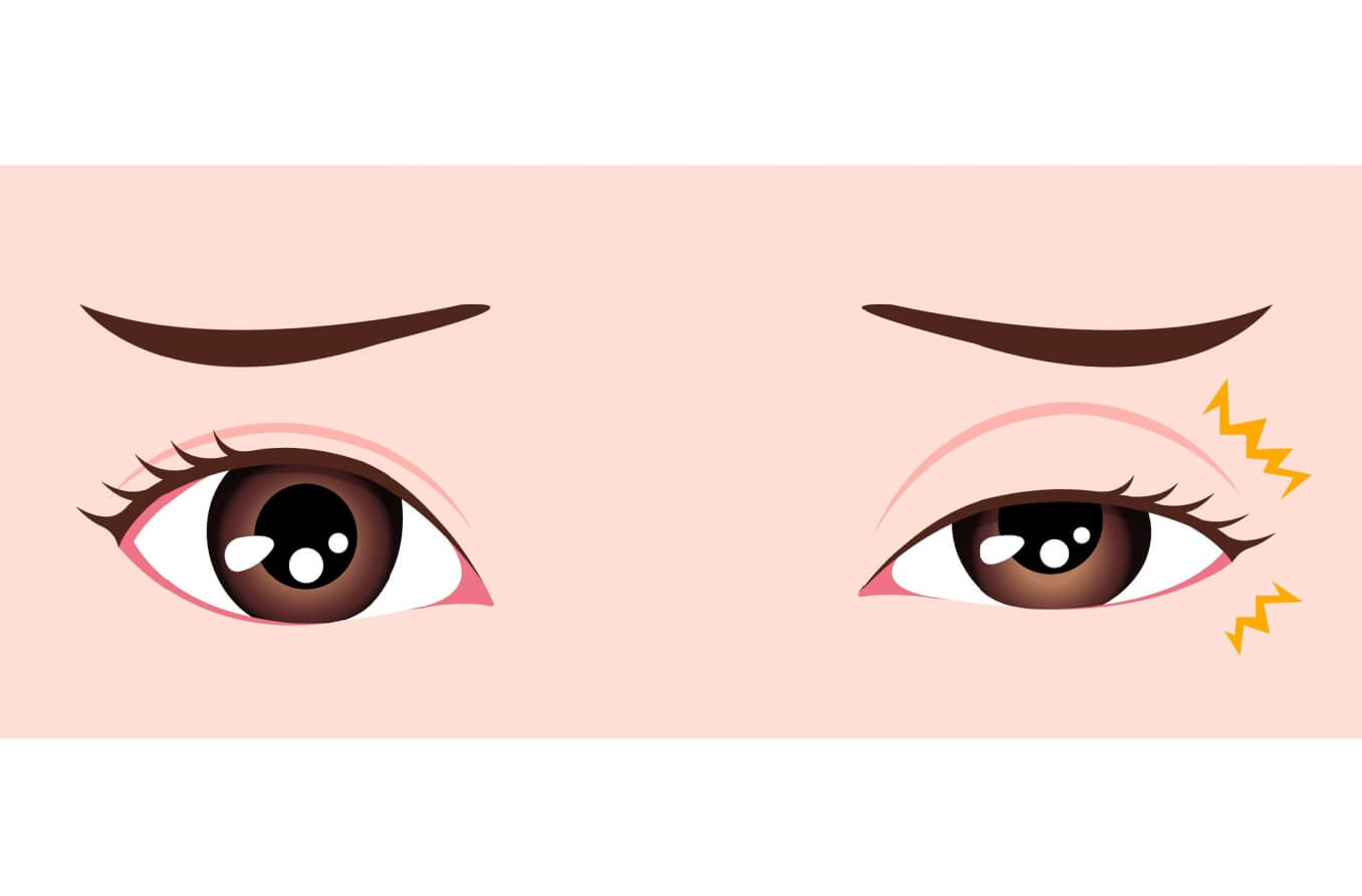 ¿Qué es la mioquimia ocular?