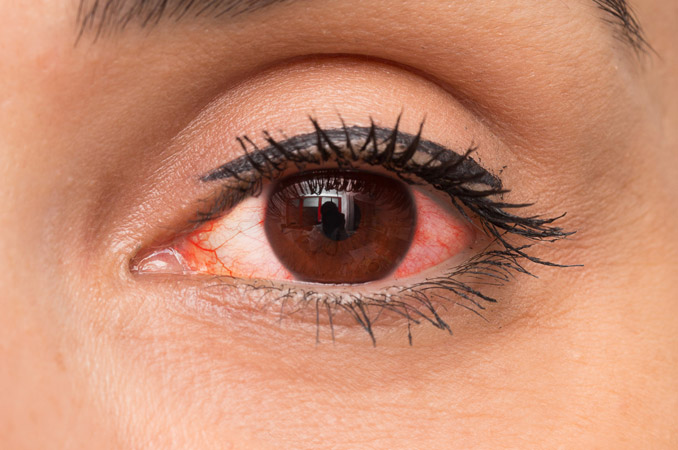 19 causas de los ojos rojos y tratamiento con gotas | All About Vision