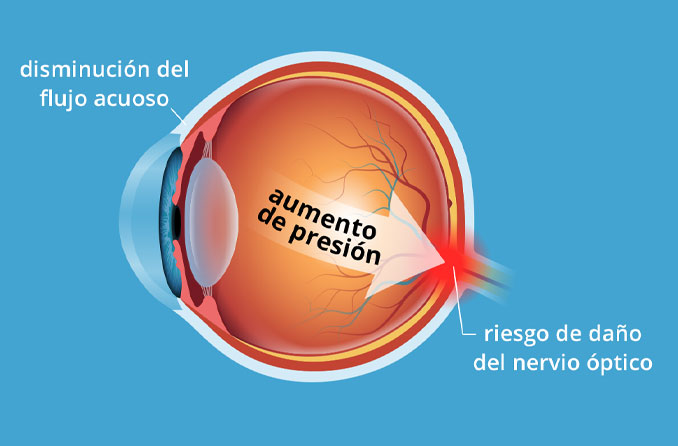 Hipertensión ocular: Causas de la tensión ocular elevada | All About Vision