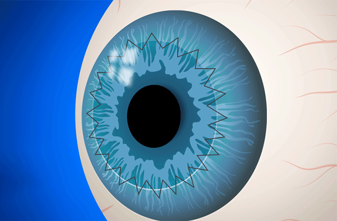 Cirugía de trasplante de córnea (queratoplastia)