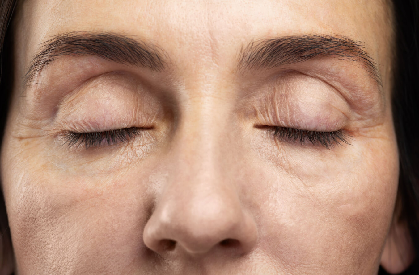 Cirugía del párpado (Blefaroplastia o lifting ocular)