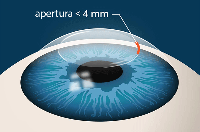 Cirugía ocular SMILE: ¿en qué se diferencia del LASIK? | All About Vision
