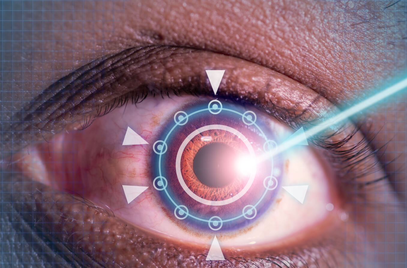 LASIK personalizado: Corrección de la visión personalizada