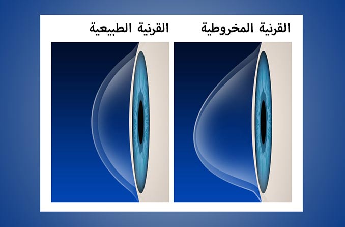 القرنية الطبيعية مقابل القرنية المخروطية