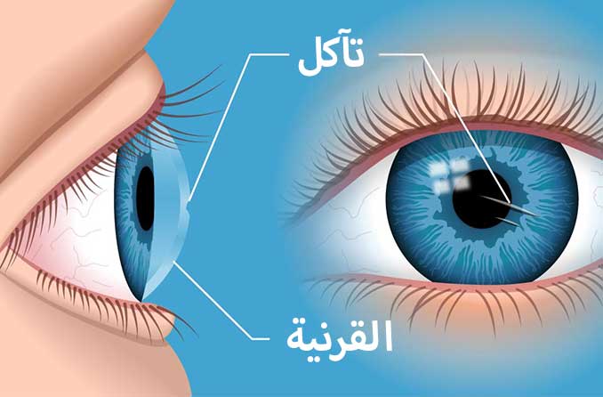 خدش القرنية: كيفية علاج العين المصابة بخدش