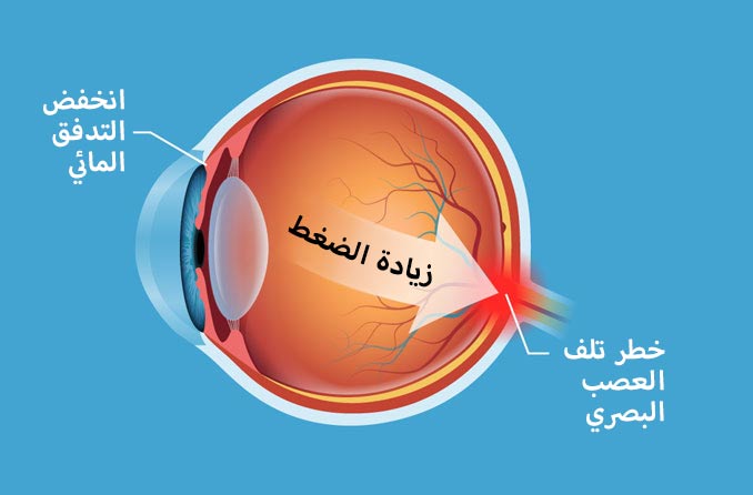 ارتفاع ضغط الدم في العين: 5 أسباب لارتفاع الضغط داخل العين 