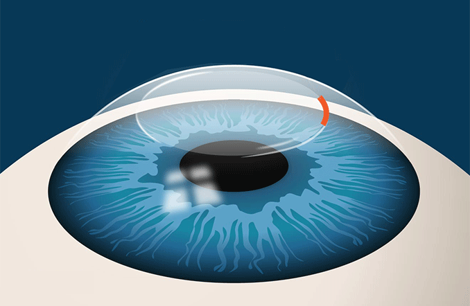 Chirurgie oculaire SMILE : correction de la myopie