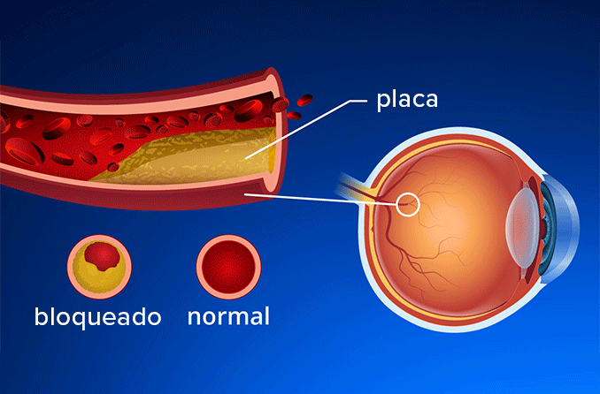 Derrames oculares: Oclusões da artéria e da veia da retina