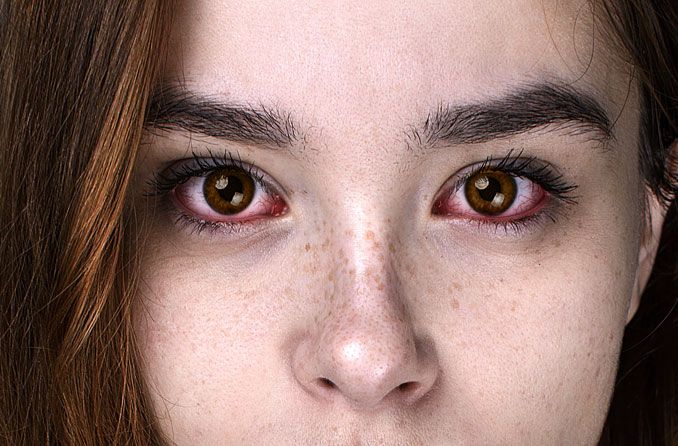 Como se pega conjutivite e por quanto tempo é contagiosa? 