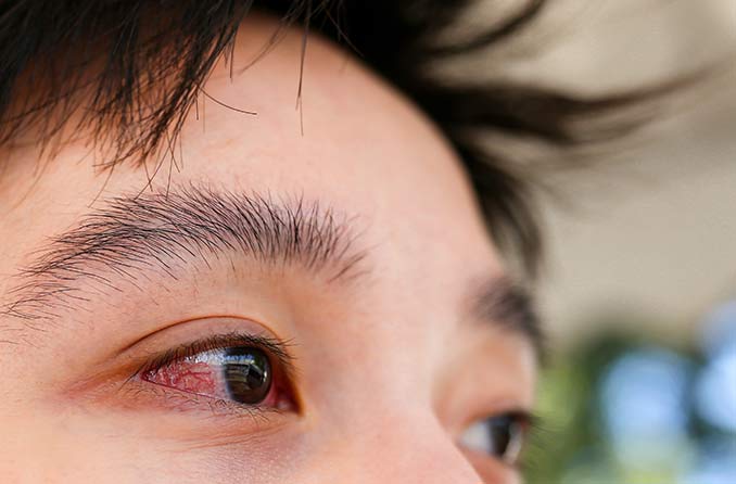結膜炎：原因と症状 | All About Vision