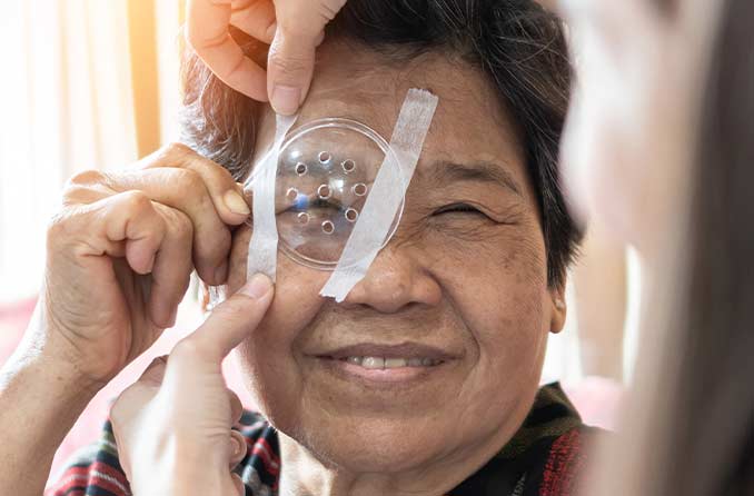 白内障手術後の回復期間を短縮するための8つのヒント：All About Vision