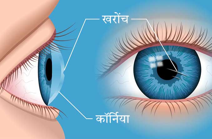 कॉर्निया का घर्षण: आँख की खरोंच का उपचार कैसे करें